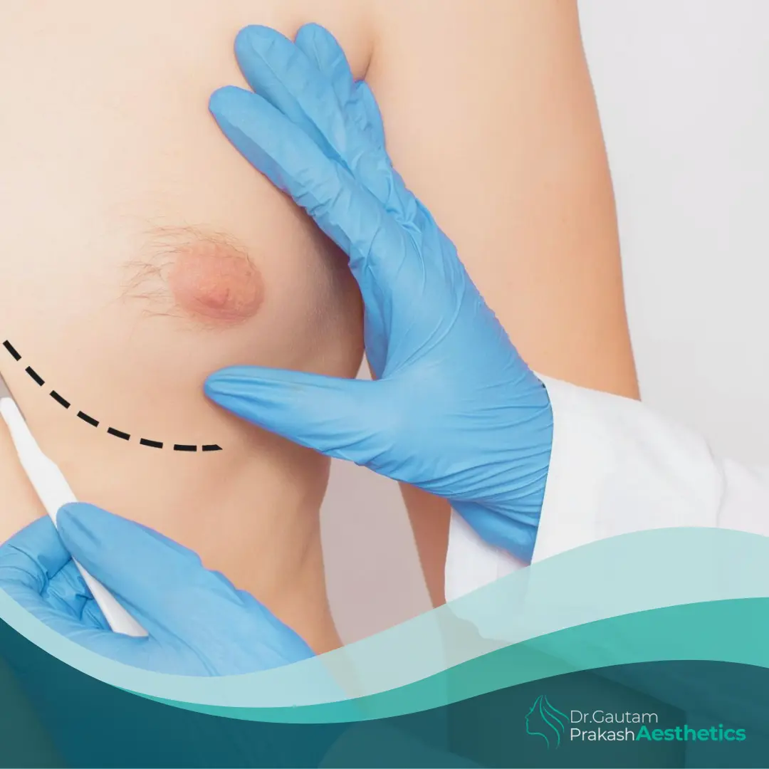 Gynecomastia Surgery