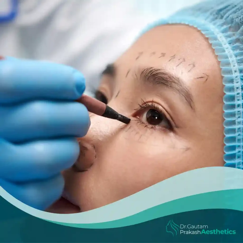 Eyelid Surgery (Blepharoplasty)​