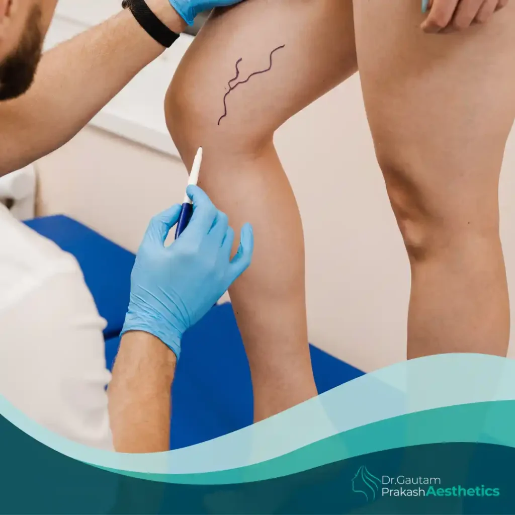 Vascular Surgery​ treatment | Dr. Gautam Prakash performing vascular surgery in Varanasi at Gautam Aesthetics.