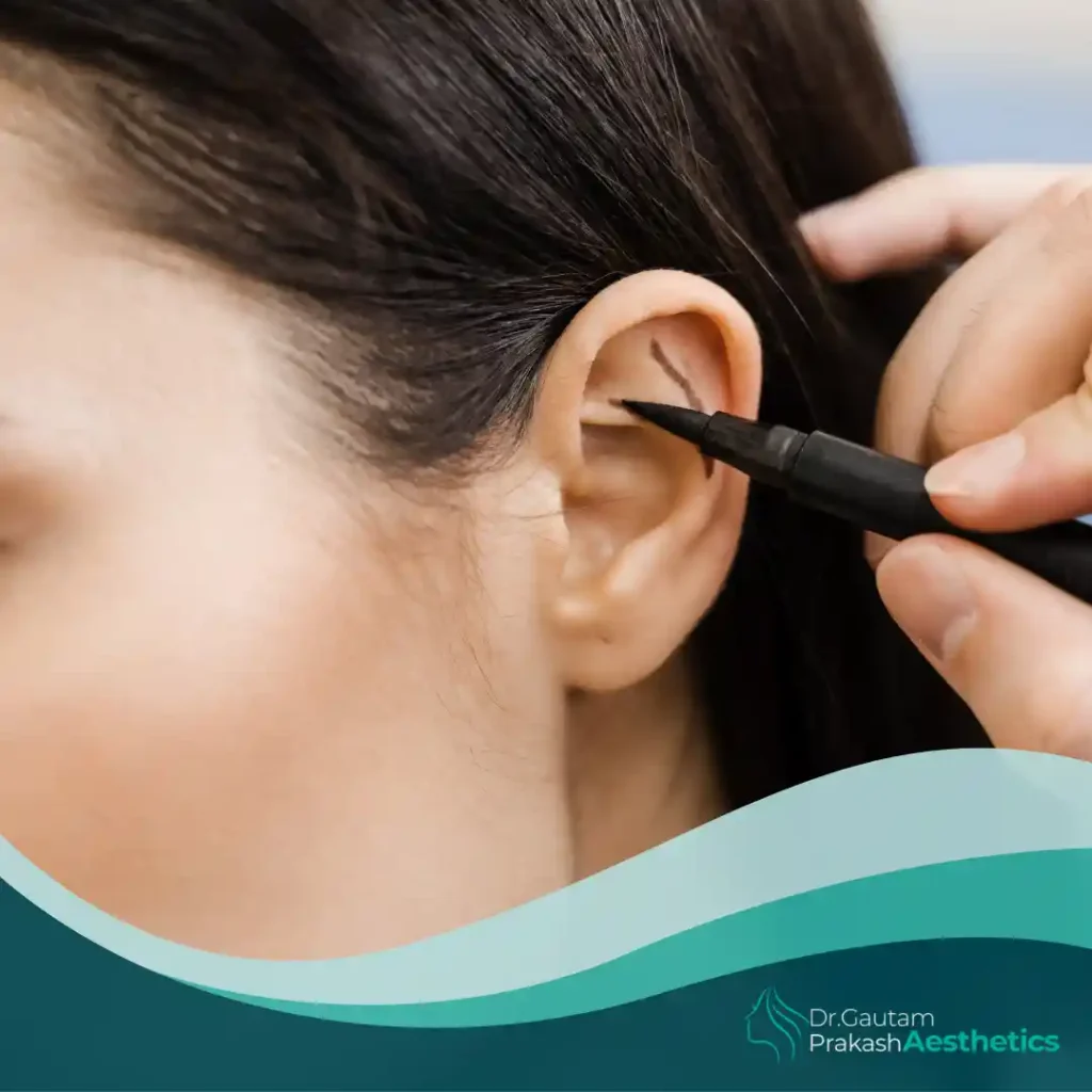 Ear Correction (Otoplasty)​