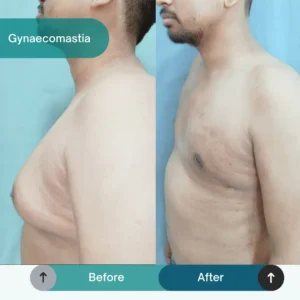 Gynecomastia Surgery in Varanasi