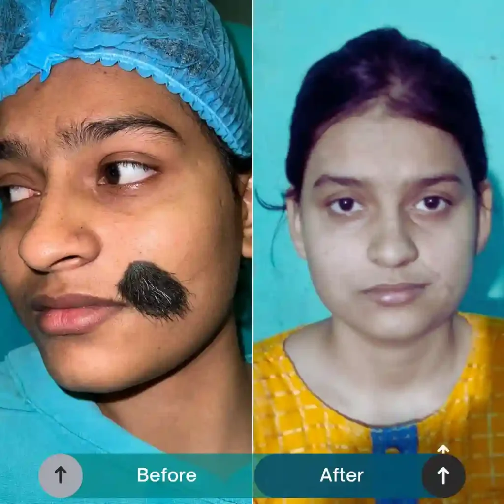 Nevus (Face) Removal​
