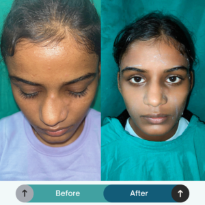 Rhinoplasty (Nose Surgery)