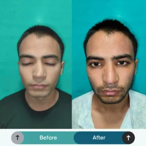 Male Rhinoplasty
