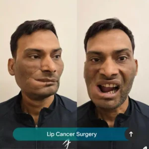 lip Cancer surgery varanasi