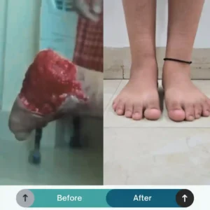 Heel trauma Surgery