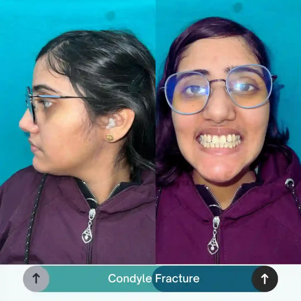 Condyle Fracture