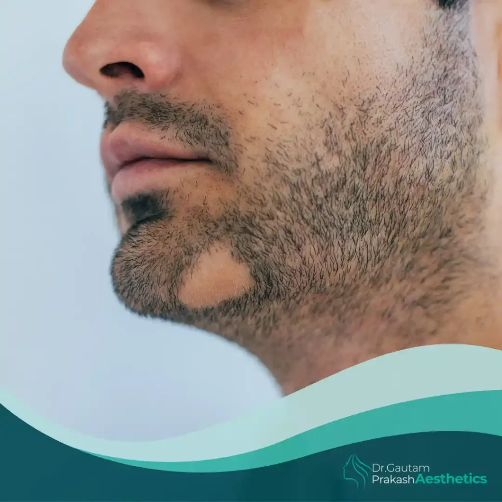 Beard Transplant​