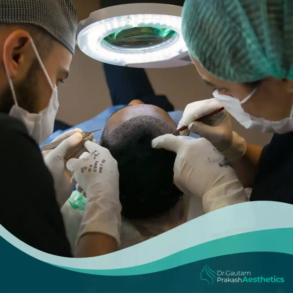 Hair Transplant​ in varanasi