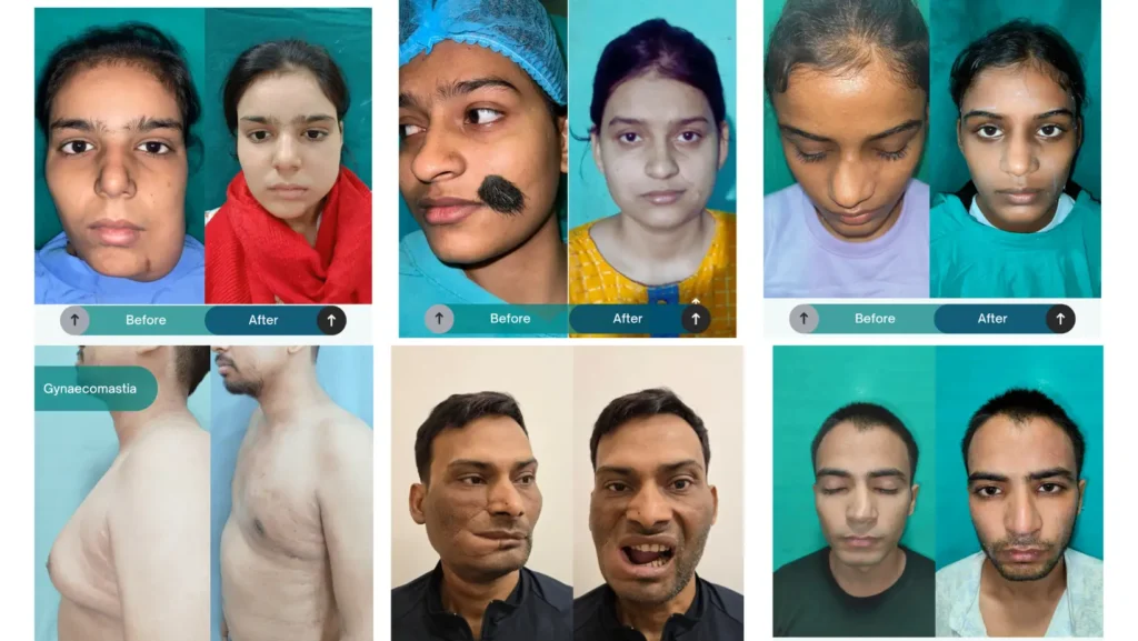 Before and after transformation of a plastic surgery patient treated by Dr. Gautam Prakash in Varanasi
