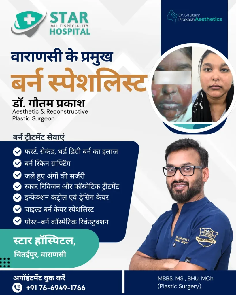 Best Burn Specialist Doctor in Varanasi – Expert Burn Treatment at Star Hospital