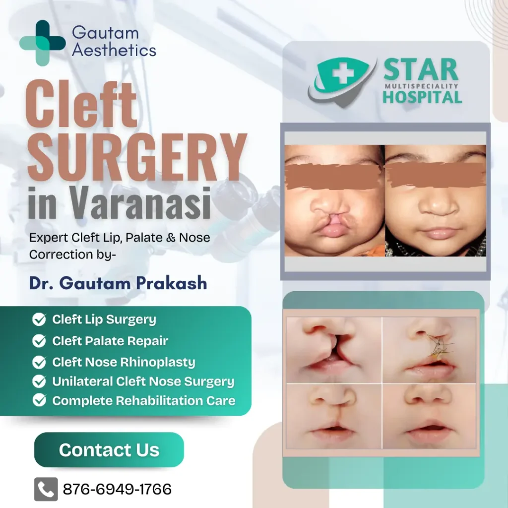 Cleft Surgery in Varanasi – Expert Cleft Lip, Palate & Nose Correction by Dr. Gautam Prakash